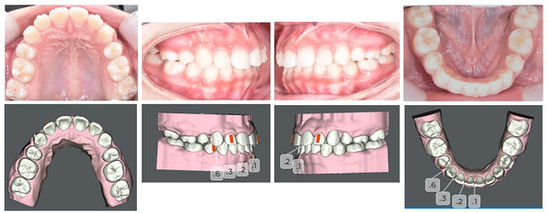Figure.11 Comparison of Intraoral Photo & Digital Staged Model Just after Stage 17(Oct. 10, 2020)