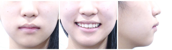 Figure.13 Final Facial Photo(Dec. 5, 2020)
